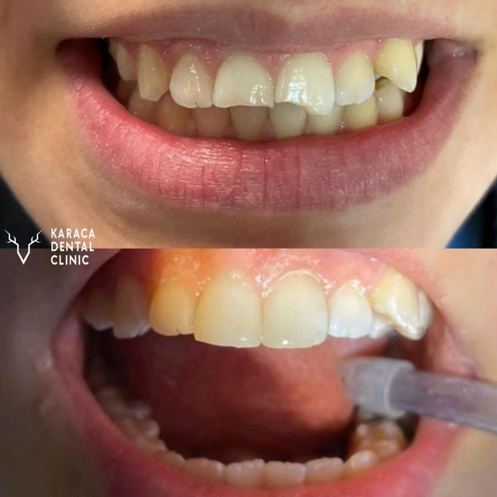 Alanyada Diş Kliniği | KARACA DENTAL CLINIC