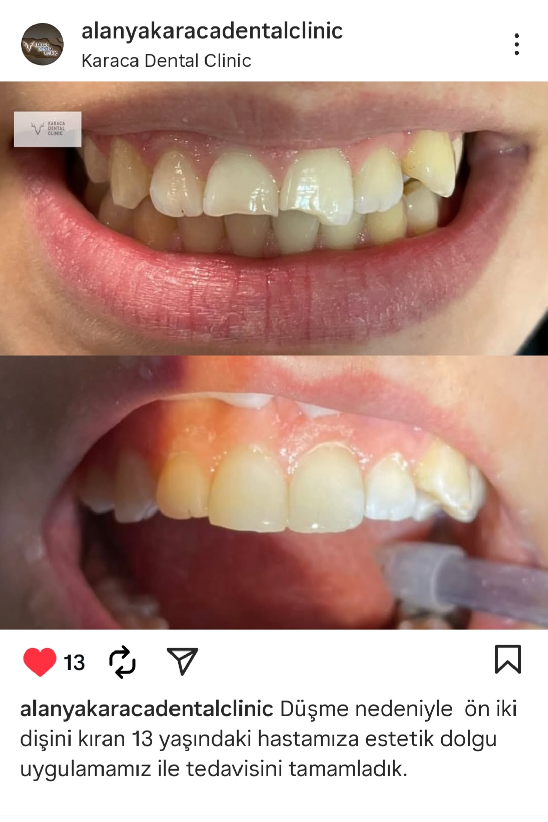 Alanyada Diş Kliniği | KARACA DENTAL CLINIC
