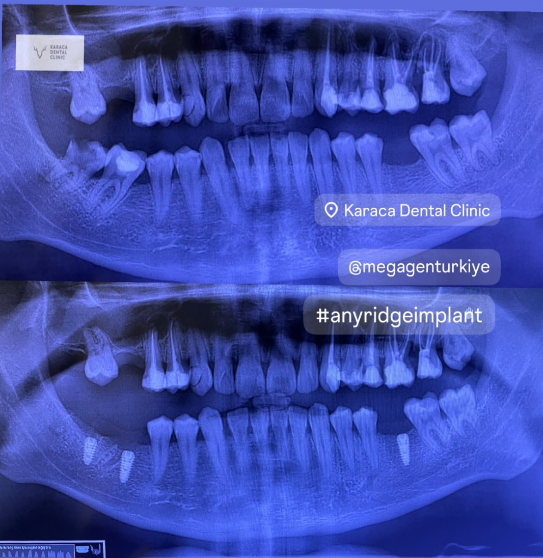 Alanyada Diş Kliniği | KARACA DENTAL CLINIC